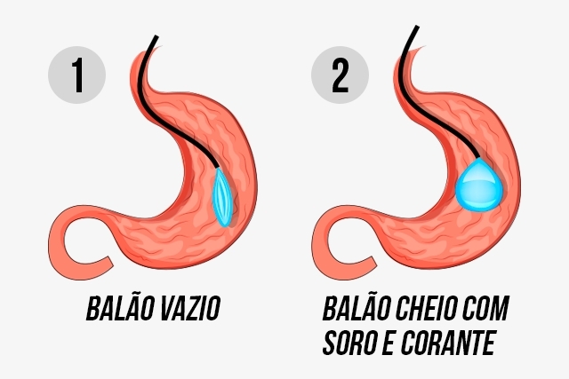 O que é o balão gástrico?