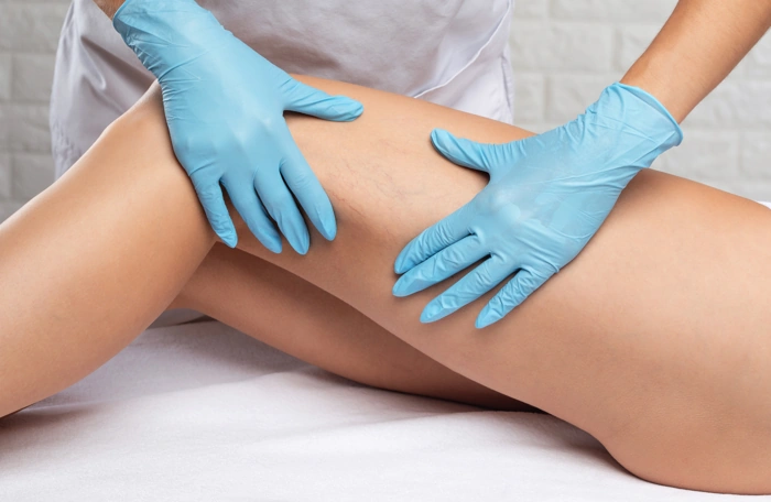 Profissional apalpa pernas de paciente em preparativo para cirurgia de varizes. Falando sobre plano de saúde cobre cirurgia de varizes a laser.
