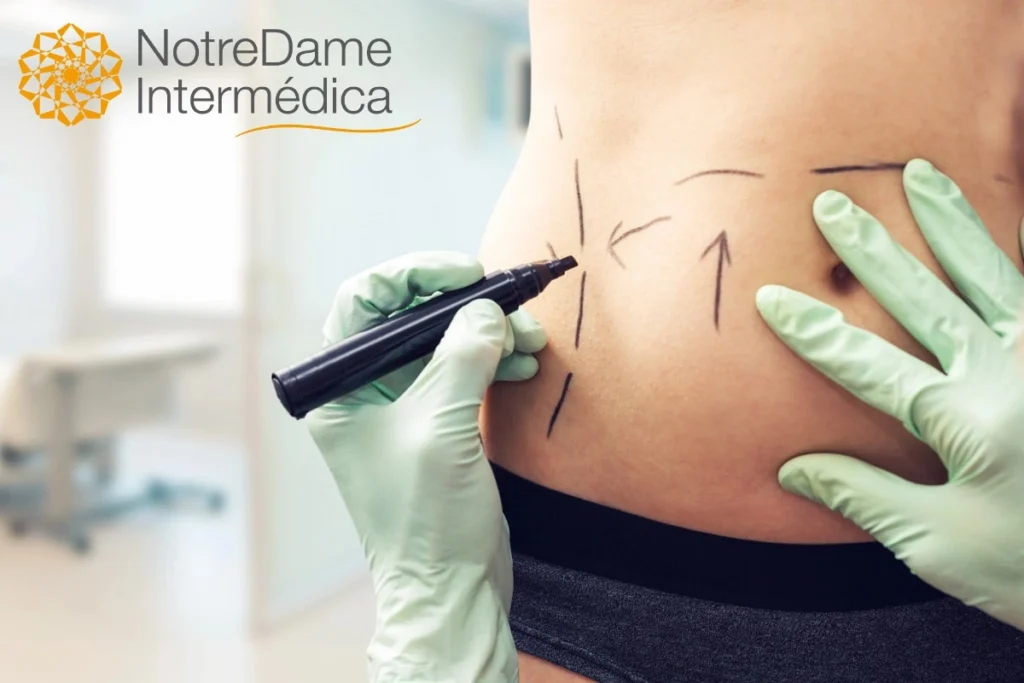 Médico faz marcações na barriga de uma mulher. Ela passará por uma abdominoplastia. Explicando se plano de saúde notredame cobre cirurgia plástica.
