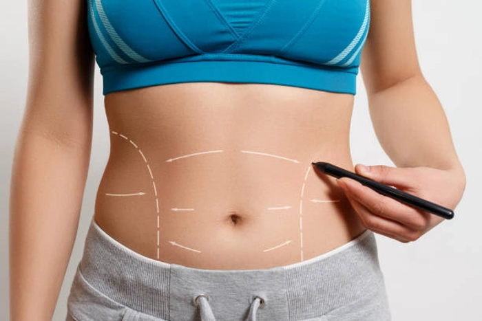Barriga de mulher marcada como que para uma cirurgia. Ela aponta uma caneta para a barriga. Explicando qual plano de saúde cobre abdominoplastia.